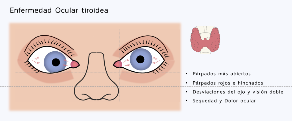 síntomas de la orbitopatía tiroidea o enfermedad ocular tiroidea. párpados más abiertos, párpados hinchados, ojo rojo, desviaciones oculares, dolor ocular.
